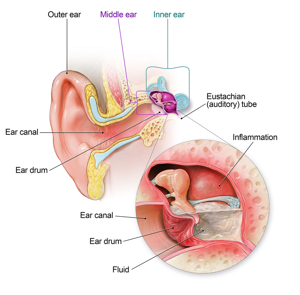 Ear Infections Pediatrics Northwest