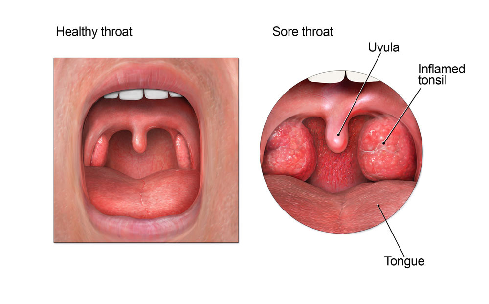 strep throat white spots on tonsils